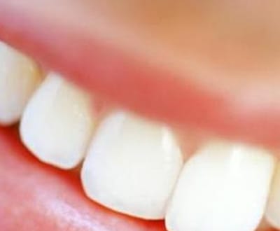 Próteses dentárias podem causar impotência - TVI