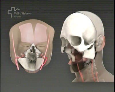 Médicos conseguem transplante total de rosto (vídeo) - TVI