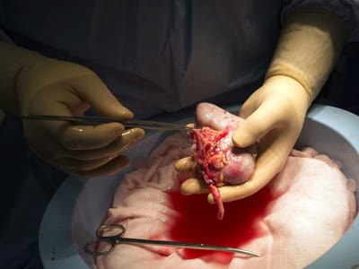 Doente terminal quer fazer transplante de cabeça - TVI