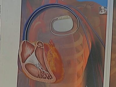 Hospital de Guimarães implanta desfibrilhadores em doentes - TVI
