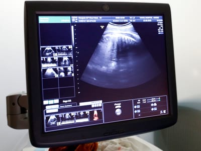 Bebé sem rosto: clínica onde foram feitas ecografias investigada - TVI