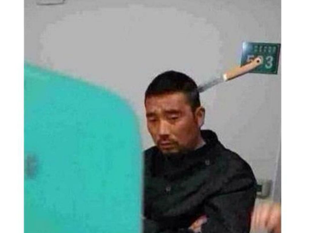 Chinês aguarda nas urgências com faca espetada na cabeça (Foto reprodução China.ong.cn)