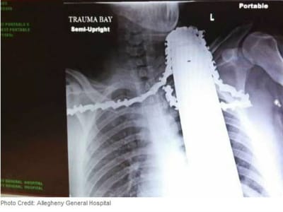 Homem atingido por lâmina de motossera no pescoço - TVI