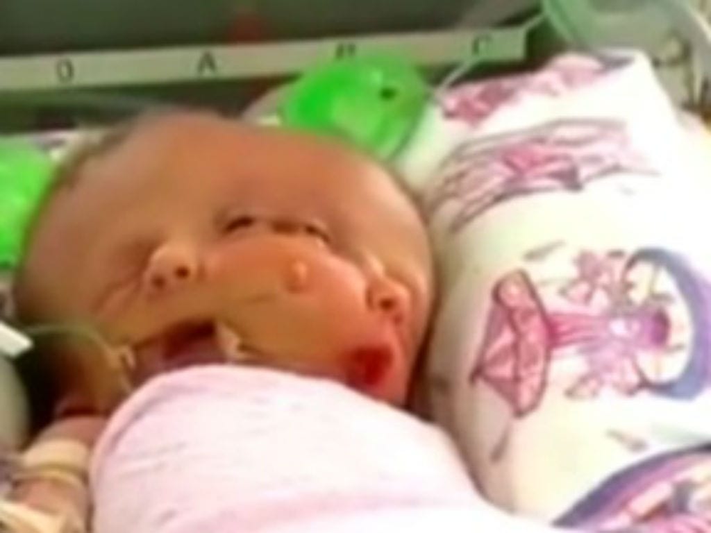 Austrália: bebé nasce com duas caras (Reprodução Youtube)