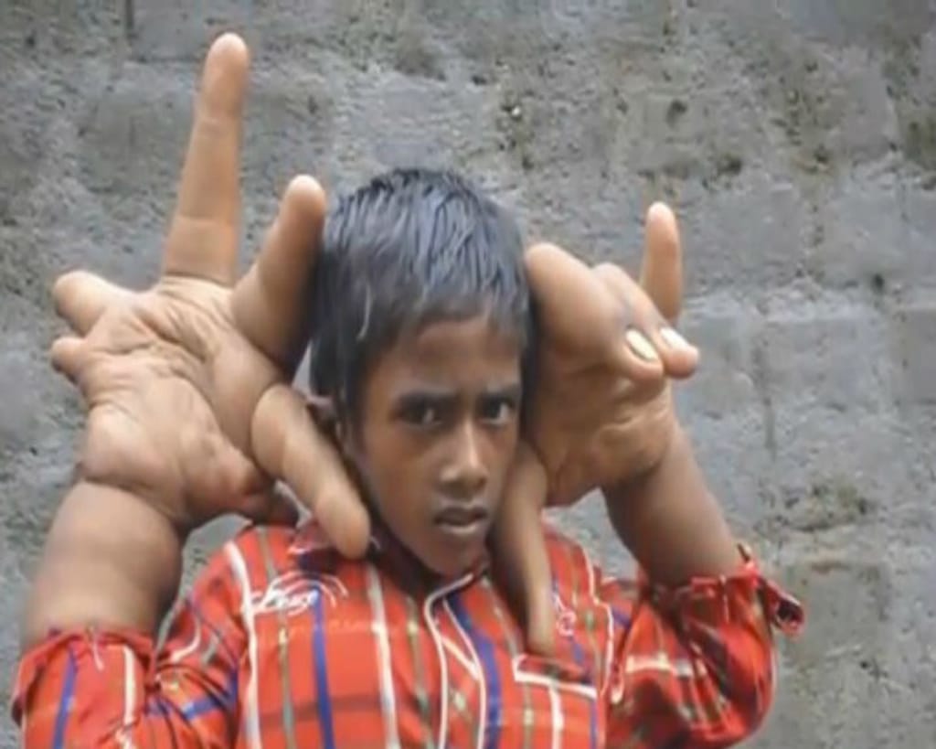 As mãos de Kaleem, de oito anos, pesam mais de 12 quilos (Reprodução/ YouTube)