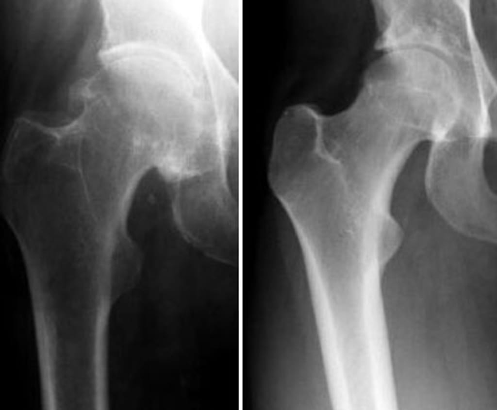 Osteoporose afecta 500 mil portugueses
