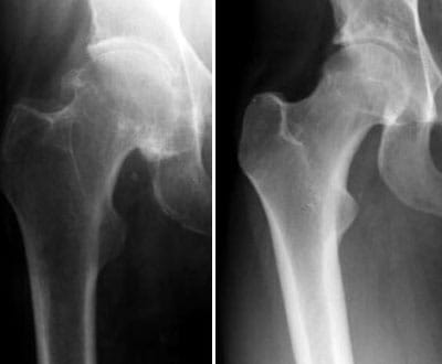 Osteoporose afecta 500 mil portugueses - TVI