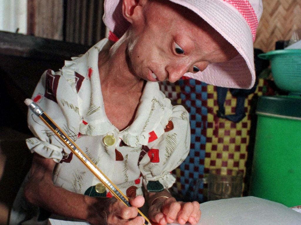 Doente de  progeria (REUTERS)