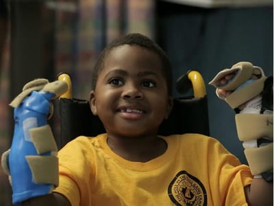 Menino de oito anos recebe transplante duplo de mãos - TVI