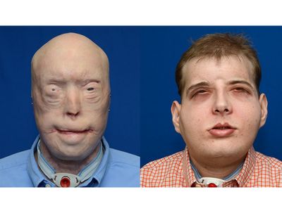 Bombeiro desfigurado recebe maior transplante facial da história - TVI