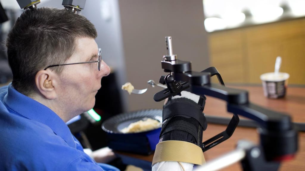 Bill Kochevar - homem implantado com sensores para poder mover os braços