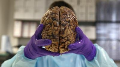 Alerta da OMS: casos de demência podem triplicar até 2050 - TVI