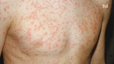 Confirmados dois casos de sarampo no norte do país - TVI