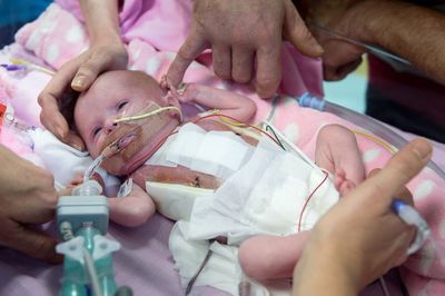 Bebé nasce com o coração fora do corpo e sobrevive miraculosamente - TVI