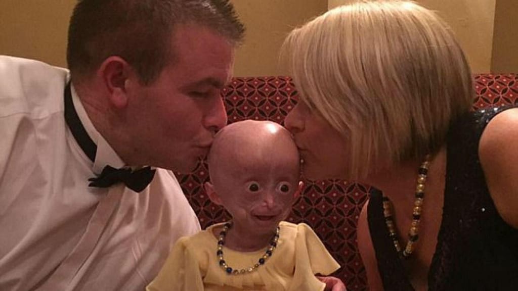 Lucy Parke sofria de progeria