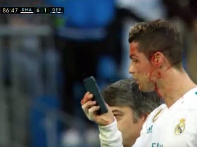 Cristiano Ronaldo pede telemóvel ao médico para ver corte feio na face - TVI