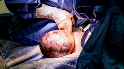 O raro momento em que um bebé nasce com o saco amniótico na cabeça - TVI