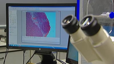 Investigadores portugueses descobrem proteína que prevê eficácia da quimioterapia no cancro da mama - TVI