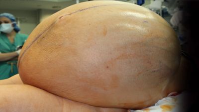 Médicos conseguem remover tumor "gigante" dos ovários de mulher - TVI