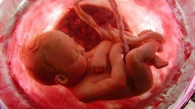Bebé nasce com feto subdesenvolvido na barriga - TVI