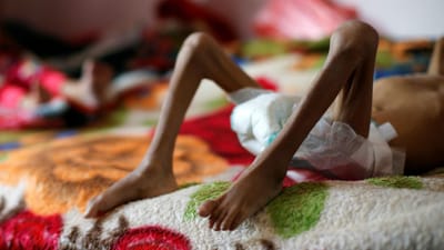 Guerra no Iémen pode ter matado à fome 85 mil crianças com menos de cinco anos - TVI
