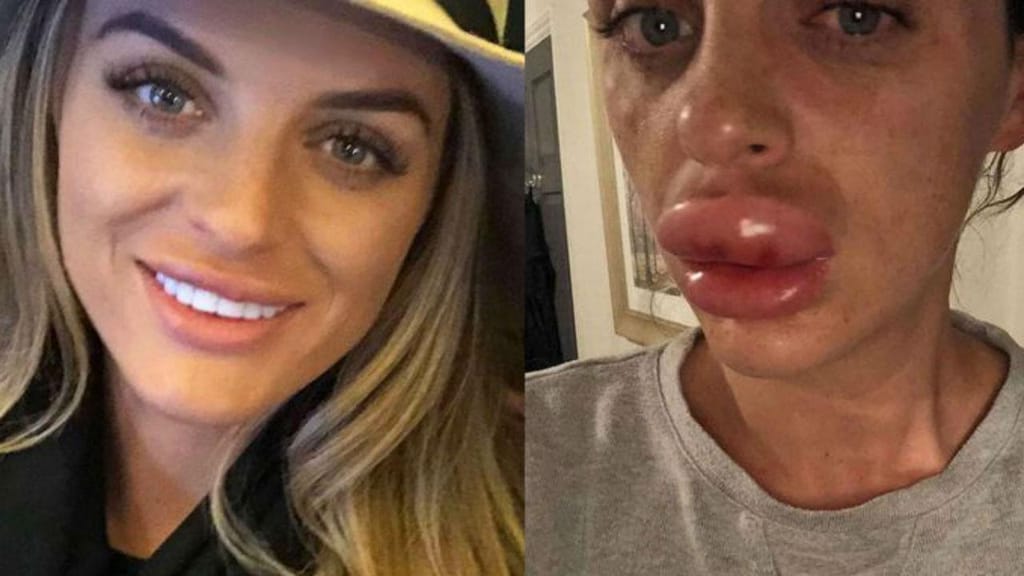 A diferença dos lábios de Rachael Knappier, após a aplicação do botox por uma esteticista não especializada