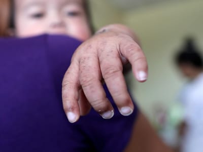 90 mil novos casos de sarampo registados na Europa na primeira metade do ano - TVI