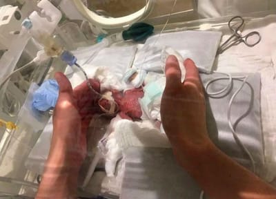 O bebé mais pequeno do mundo nasceu com 268 gramas - TVI