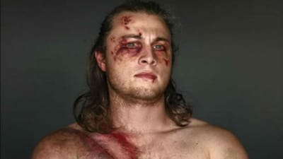 Dez homens feridos em acidentes dão a cara pelo cinto de segurança - TVI
