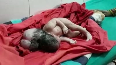 Bebé nasce com "três cabeças" na Índia - TVI