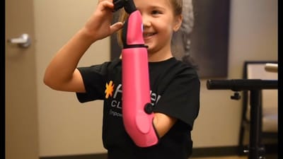Menina de oito anos é a mais nova de sempre nos EUA a receber um braço biónico - TVI