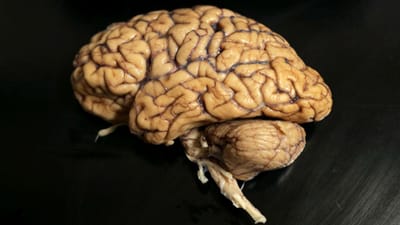 Cientistas fazem descoberta importante para travar tumores cerebrais graves - TVI