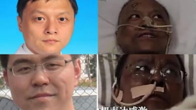 Dois médicos chineses ficam com a pele negra após tratamento à Covid-19 - TVI
