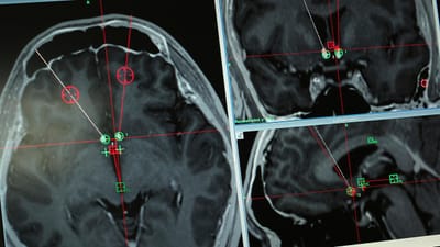 Capacete magnético eficaz na regressão de cancro no cérebro - TVI