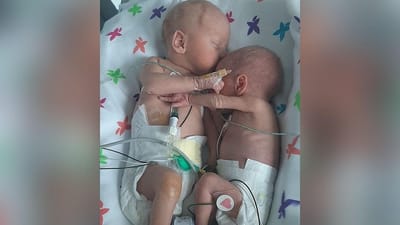 O momento em que dois gémeos se abraçaram após semanas separados em hospital - TVI