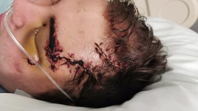 Doente agredido com ferro no Hospital de Cascais - TVI