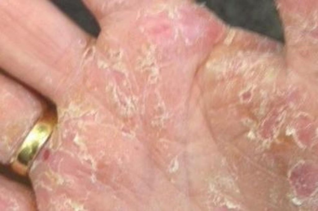 Eczema nas mãos