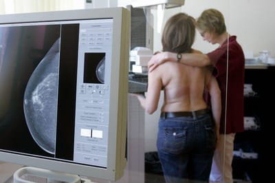 Sociedade defende teste genético em todas as mulheres com cancro da mama até os 45 anos - TVI