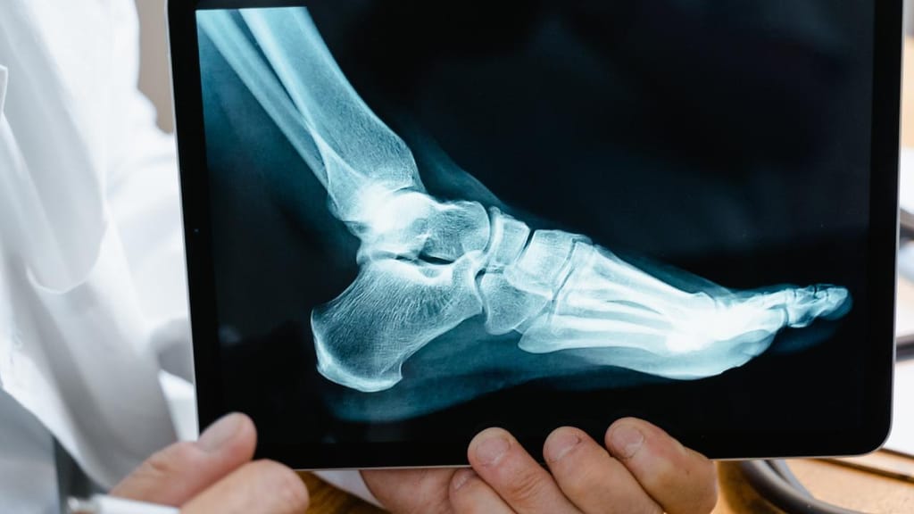 No caso das patologias ortopédicas que requerem cirurgia, “a dificuldade de marcha, as dores crónicas e a incapacidade no dia a dia” são apenas três consequências diretas do atraso do tratamento, diz o médico Nuno Neves. (Pexels)