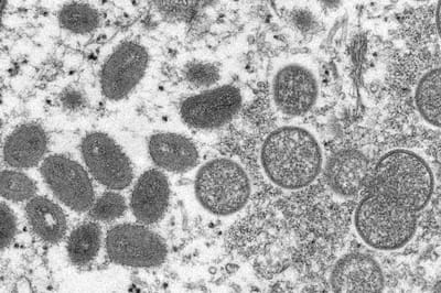 Como chegou a varíola dos macacos à Europa? Uma possível explicação - TVI