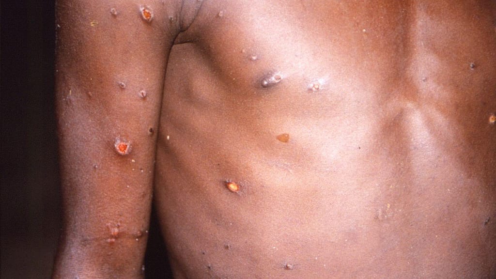 Monkeypox (CDC)