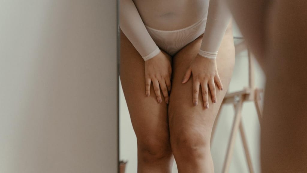 Quando a gordura das pernas se destaca do resto do corpo. 10 respostas  sobre lipedema - CNN Portugal