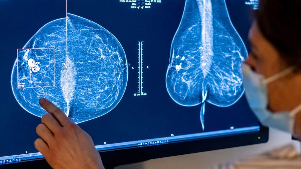 Mamografia (Michael Hanschke/Getty Images)