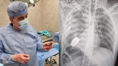 Cirurgião retira granada ativa do corpo de um soldado ucraniano - TVI