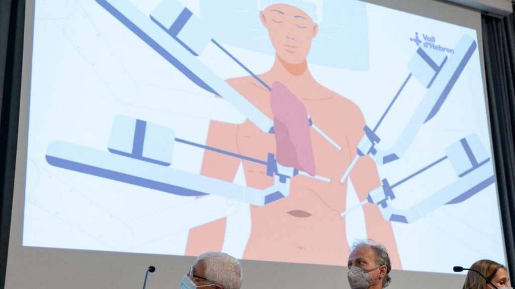 Xavier, 65 anos, tecve o primeiro transplante de pulmão robotizado no hospital Vall d'Hebron em Barcelona, 17 de April, 2023. (Josep Lago/ Getty Images)