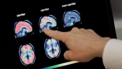 Como a mudança dos padrões de vida pode originar mais doentes de Alzheimer. "Número de casos em Portugal é muito superior ao que se pensava" - TVI