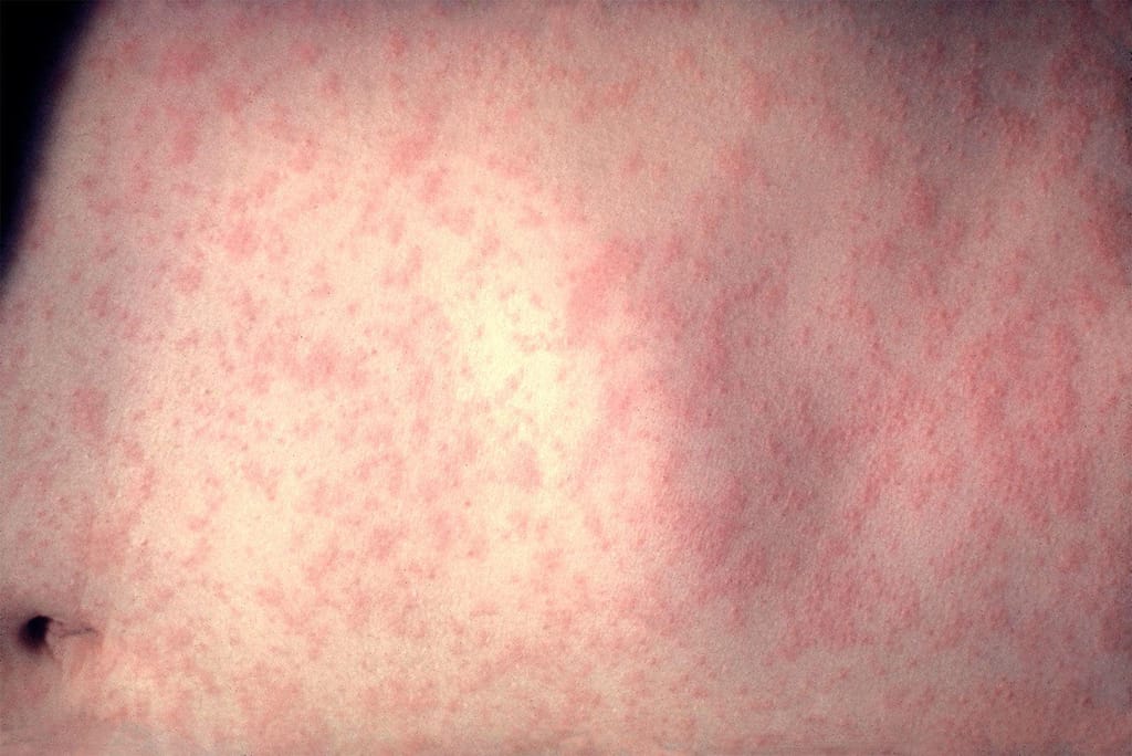 Os EUA registaram mais de 120 casos de sarampo em 20 zonas do país, segundo o CDC. CDC/FILE