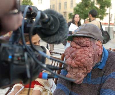 Homem «sem rosto» do Rossio remove tumor de cinco quilos - TVI